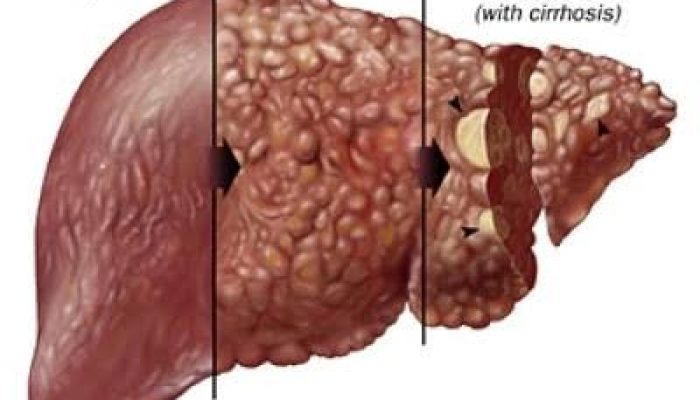 Signs of Liver Disease and Damage