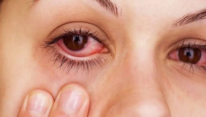 Causes of Eye Pain