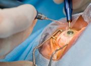 Eye Surgery Types, Procedures, and Benefits