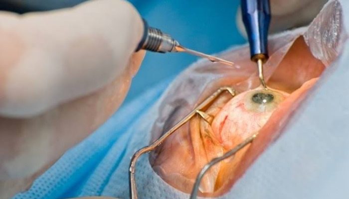 Eye Surgery Types, Procedures, and Benefits