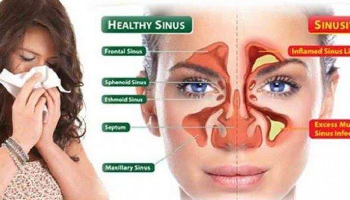 Nose Diseases: Types, Causes, and Treatments